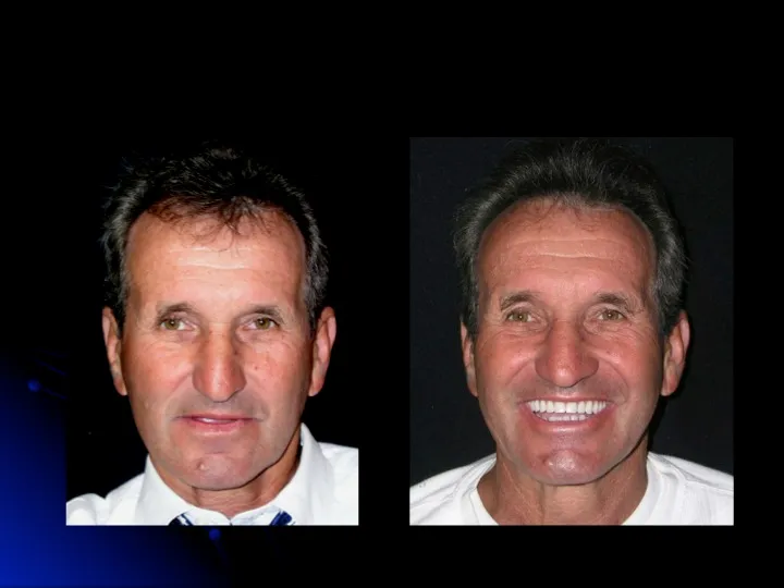 Before and after Teeth in a Day