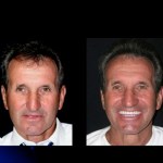 Before and after Teeth in a Day
