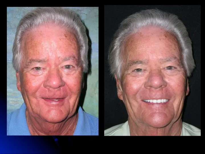 Before and after Teeth in a Day
