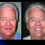 Before and after Teeth in a Day
