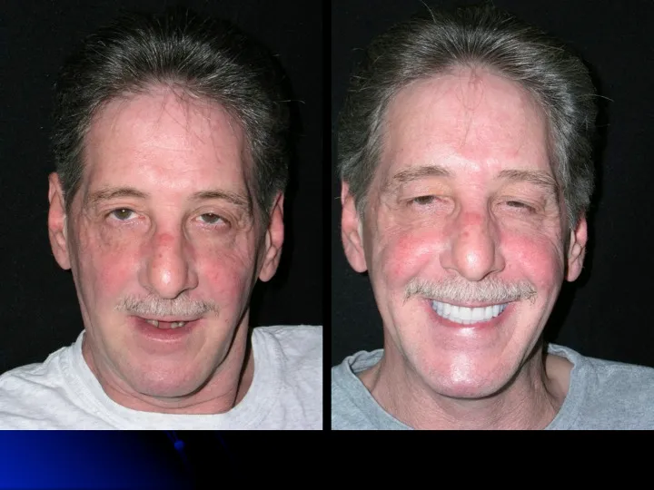 Before and after Teeth in a Day