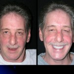 Before and after Teeth in a Day