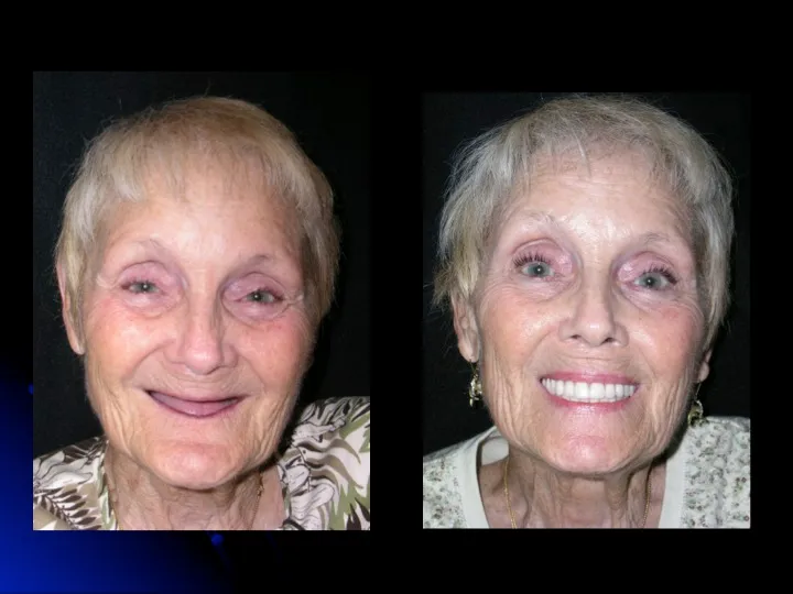 Before and after Teeth in a Day