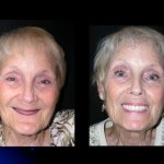 Before and after Teeth in a Day