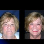 Before and after Teeth in a Day