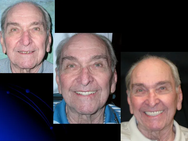 Before and after Teeth in a Day
